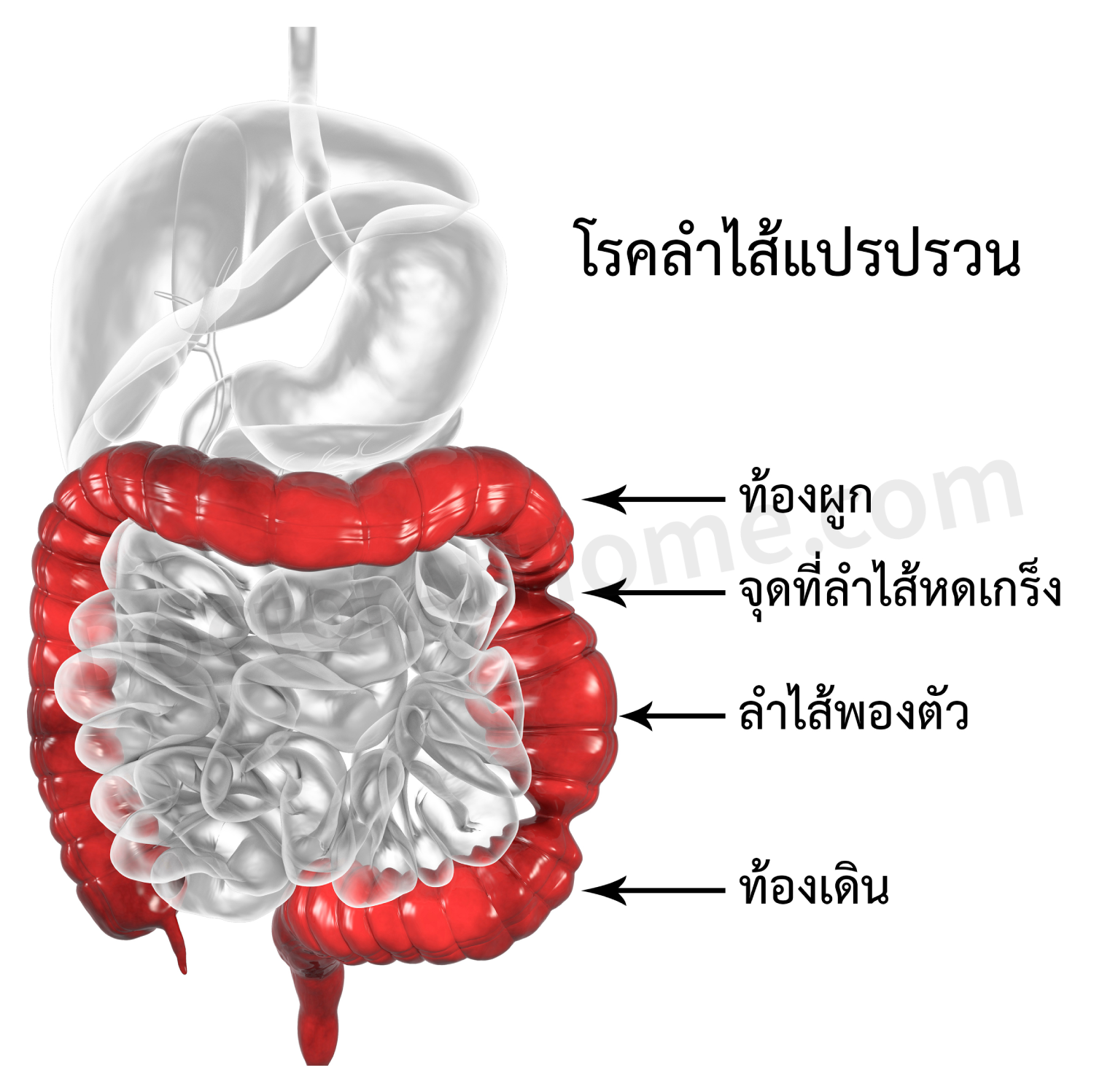 โรคลำไส้แปรปรวน